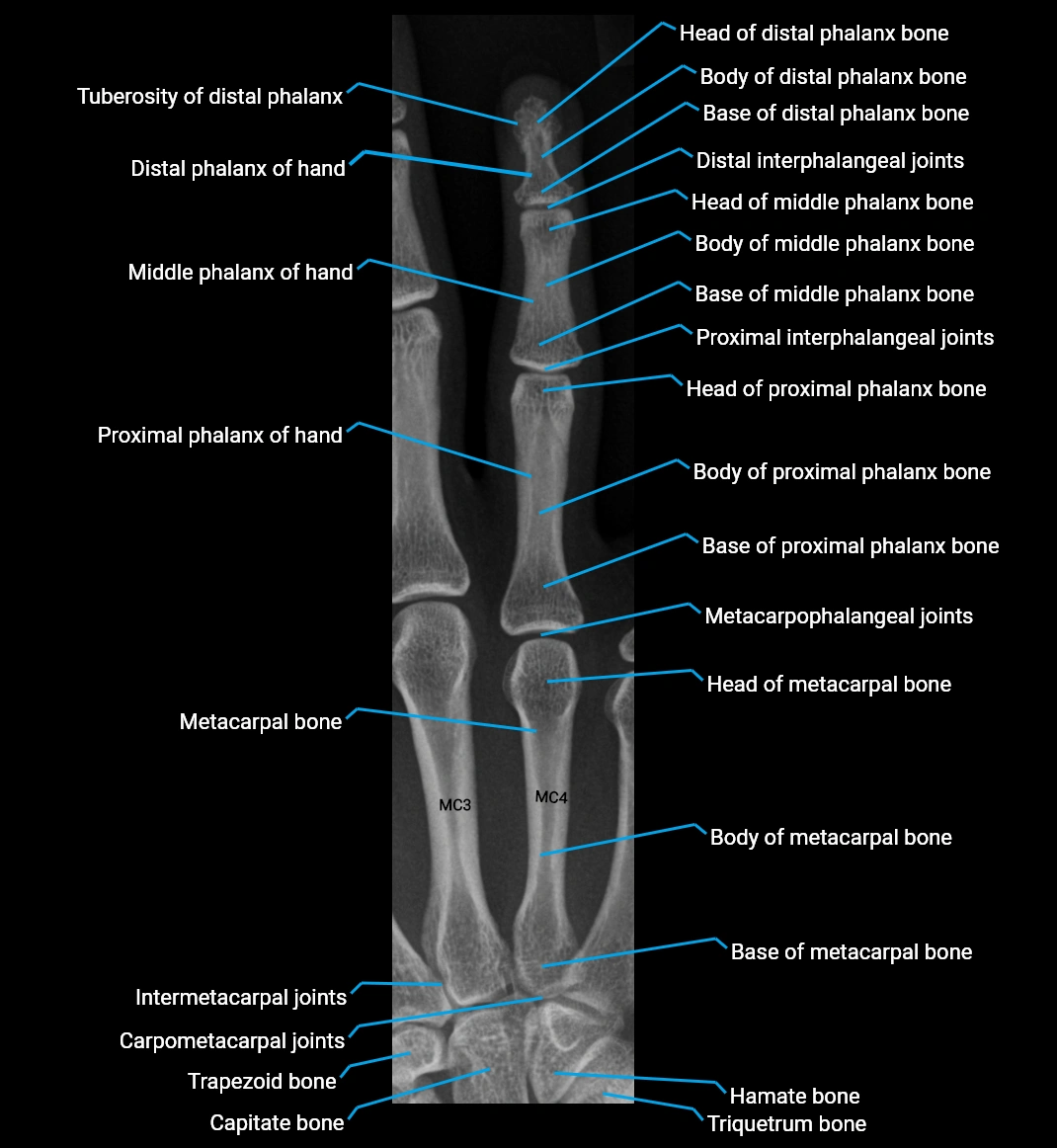 X Ray finger  AP anatomy labelled.webp